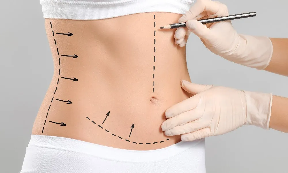 Liposuzione con gravi complicazioni, 33enne fa causa